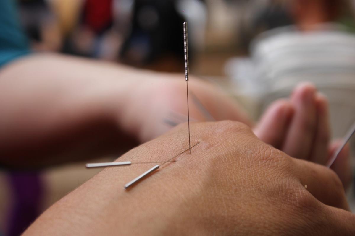 Acupuncture : dans quels cas cette pratique peut vraiment aider ?